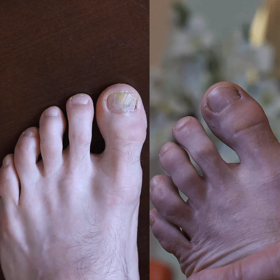 The Inside-Out Complete Solution for Nail Fungus - Image 7