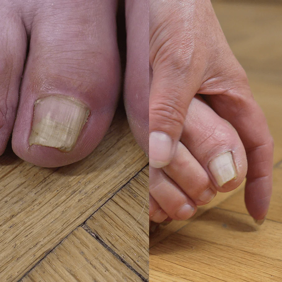 The Inside-Out Complete Solution for Nail Fungus - Image 8